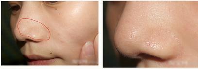 鸡蛋清去黑头效果真的那么神奇吗,用鸡蛋清去黑头靠谱吗