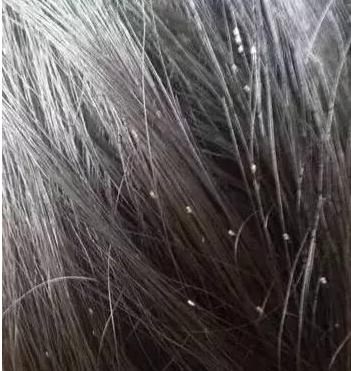 长头虱每天洗头效果好吗,女孩经常洗头怎么会长头虱