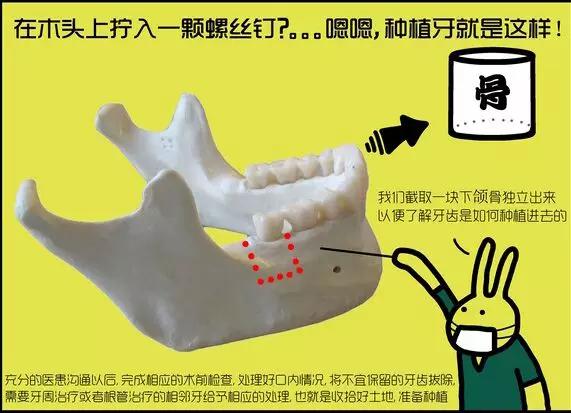 种植牙科普漫画,种植牙漫画素材