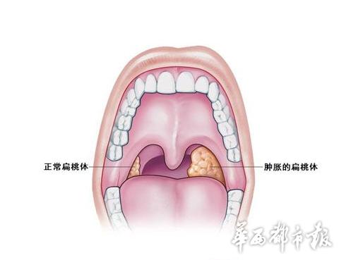扁桃体反复发炎是免疫力降落吗,扁桃体反复发炎可能是大病警报