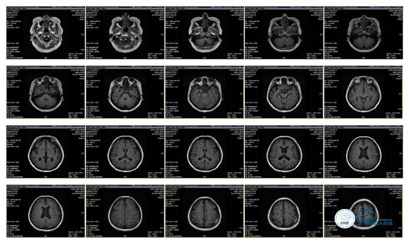 静脉窦狭窄支架植入术,静脉窦狭窄做支架多少钱