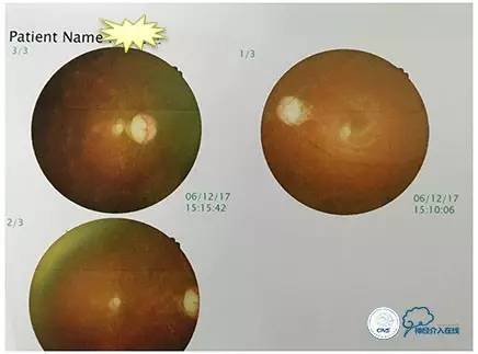 静脉窦狭窄支架植入术,静脉窦狭窄做支架多少钱