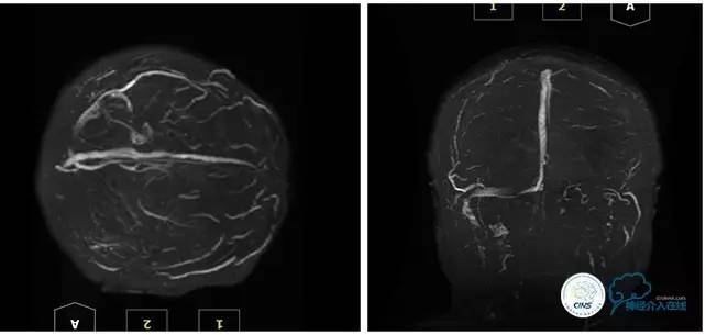 静脉窦狭窄支架植入术,静脉窦狭窄做支架多少钱