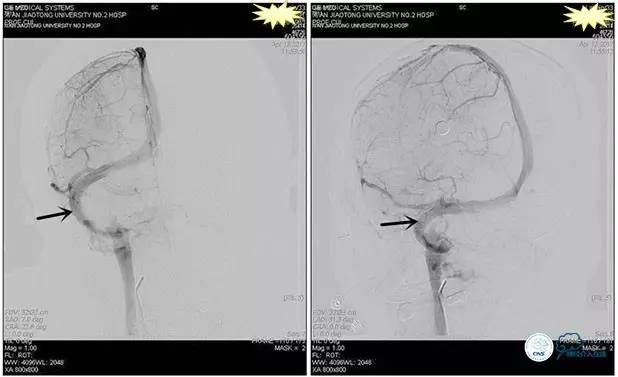 静脉窦狭窄支架植入术,静脉窦狭窄做支架多少钱