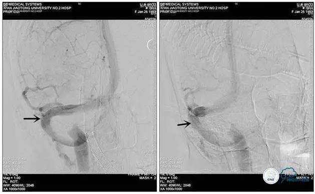 静脉窦狭窄支架植入术,静脉窦狭窄做支架多少钱