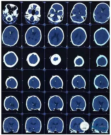 静脉窦狭窄支架植入术,静脉窦狭窄做支架多少钱