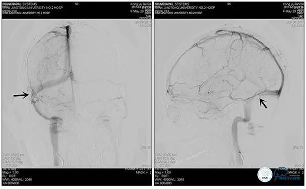 静脉窦狭窄支架植入术,静脉窦狭窄做支架多少钱