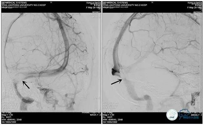 静脉窦狭窄支架植入术,静脉窦狭窄做支架多少钱