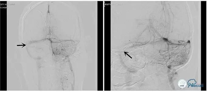 静脉窦狭窄支架植入术,静脉窦狭窄做支架多少钱