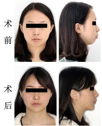 龅牙地包天怎么弄,龅牙怎么解决最好