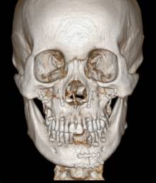 龅牙地包天怎么弄,龅牙怎么解决最好