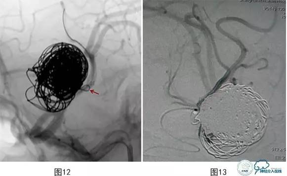 颅内动脉瘤血管内治疗的缺血性并发症