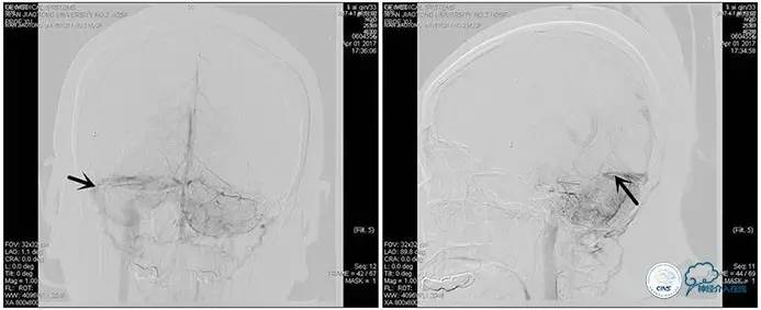 静脉窦狭窄支架植入术,静脉窦狭窄做支架多少钱
