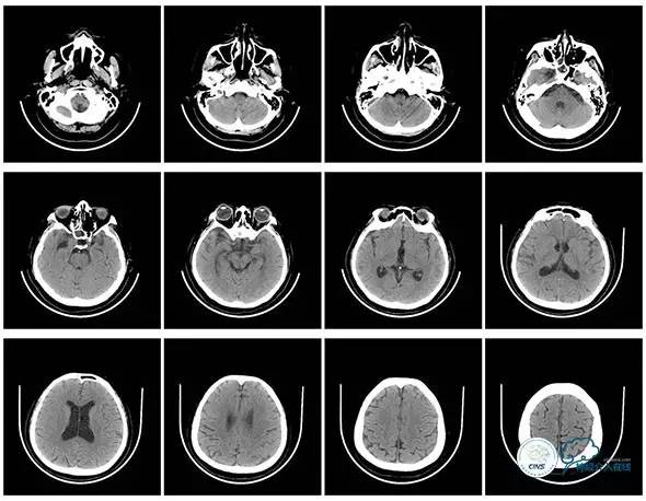 静脉窦狭窄支架植入术,静脉窦狭窄做支架多少钱