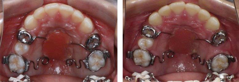 龅牙地包天怎么弄,龅牙怎么解决最好