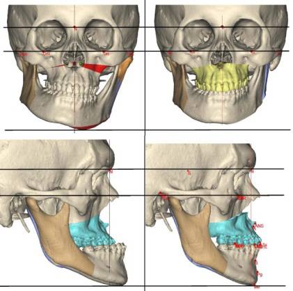 龅牙地包天怎么弄,龅牙怎么解决最好