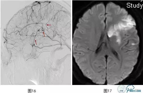 颅内动脉瘤血管内治疗的缺血性并发症