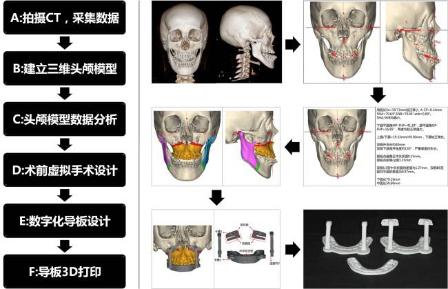 龅牙地包天怎么弄,龅牙怎么解决最好