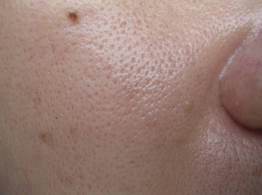 战痘｜史上最全”战痘“解答50+合集！