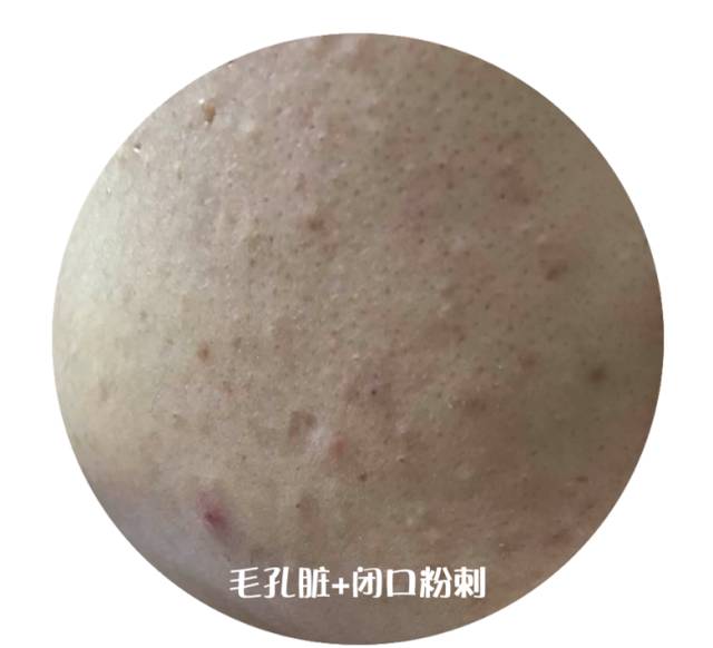 战痘｜史上最全”战痘“解答50+合集！