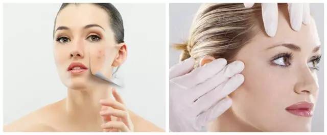 战痘｜史上最全”战痘“解答50+合集！