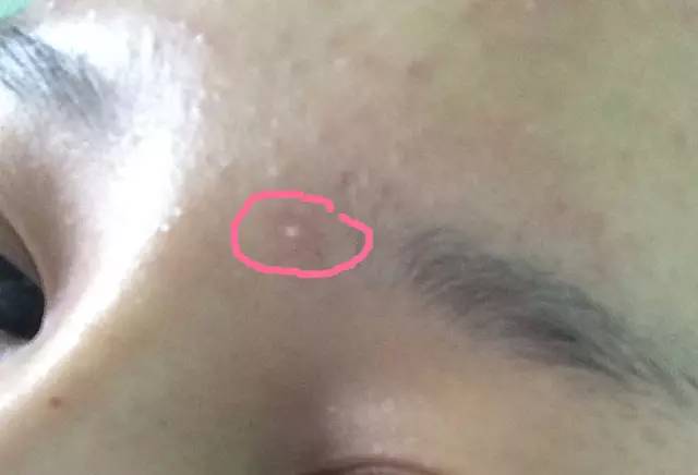 战痘｜史上最全”战痘“解答50+合集！