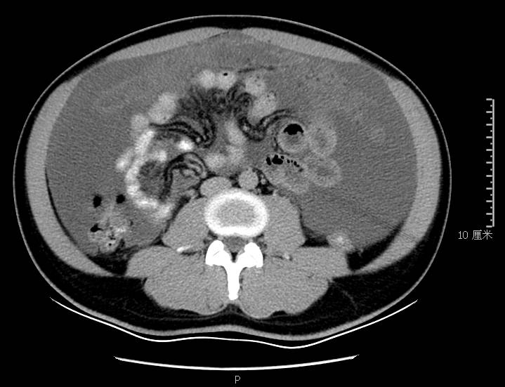 腹胀是怎么回事小心是这里生病了,腹胀是什么原因引起的胃不舒服