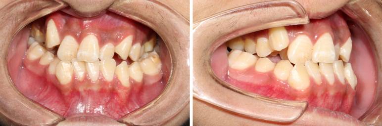 龅牙地包天怎么弄,龅牙怎么解决最好