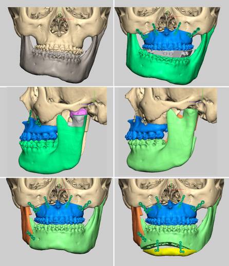 龅牙地包天怎么弄,龅牙怎么解决最好