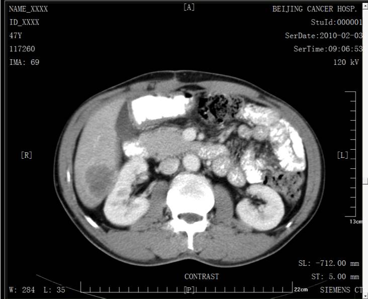 病例转移,胰腺癌晚期肝和腹腔转移