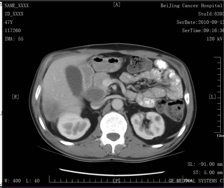 病例转移,胰腺癌晚期肝和腹腔转移