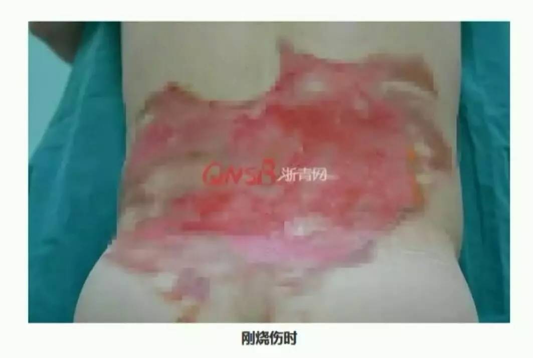 男子拔火罐被烧伤,男子拔罐被烧伤
