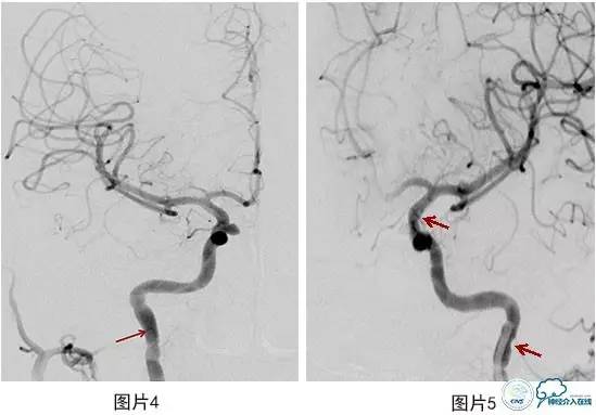 颅内动脉瘤血管内治疗的缺血性并发症