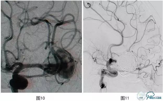 颅内动脉瘤血管内治疗的缺血性并发症