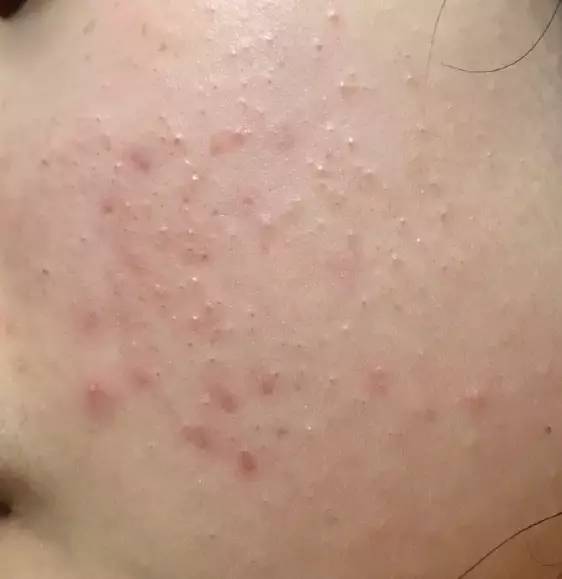 战痘｜史上最全”战痘“解答50+合集！