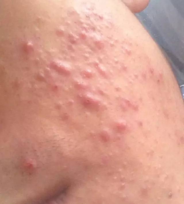 战痘｜史上最全”战痘“解答50+合集！