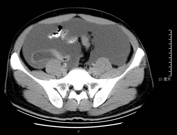 腹胀是怎么回事小心是这里生病了,腹胀是什么原因引起的胃不舒服