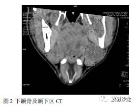 下颌下腺肿瘤是什么原因引起的,下颌下腺瘤有什么症状