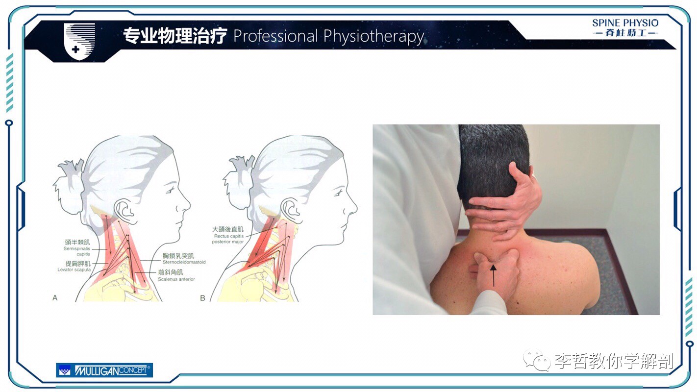 24度颈部大包怎么去除,颈后大包通过训练消除