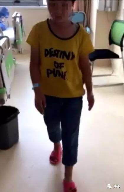 turner综合征小女孩特征,turner综合征患者身材矮小