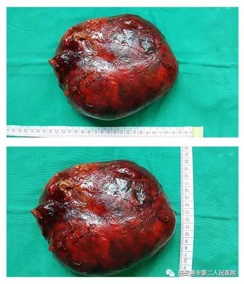 “保肾取瘤”市第二人民医院泌尿外科再创手术新高度