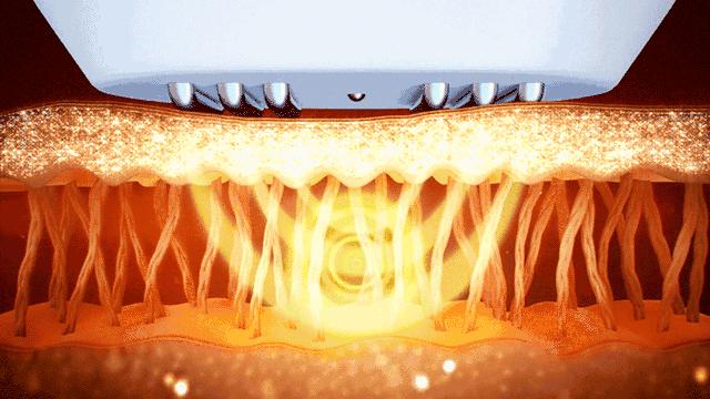 好物黑科技产品,以色列射频美容仪川字纹
