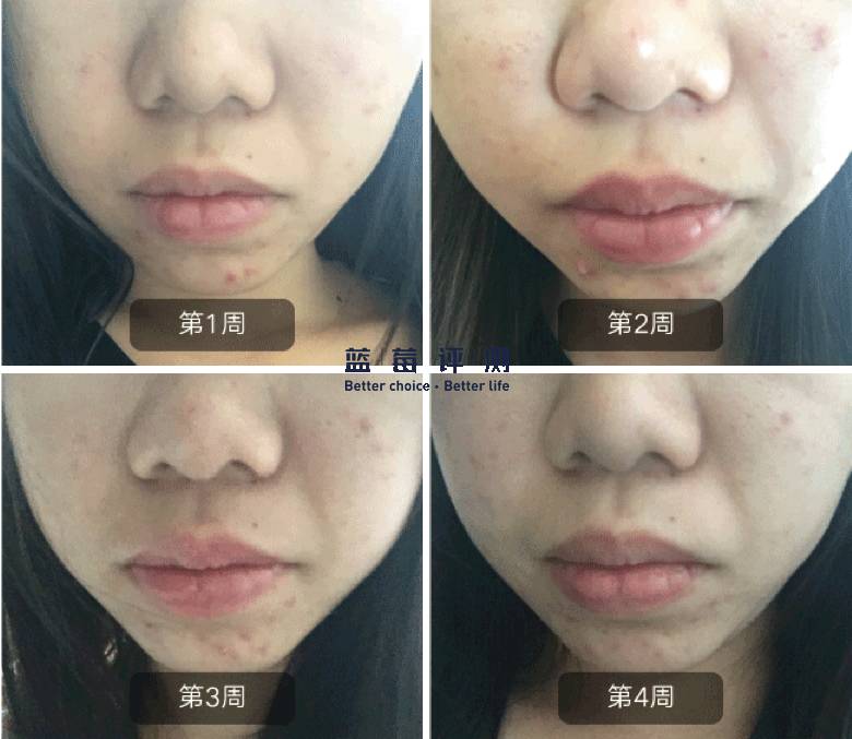 十大公认最好的美容仪,目前最好的美容仪是哪种