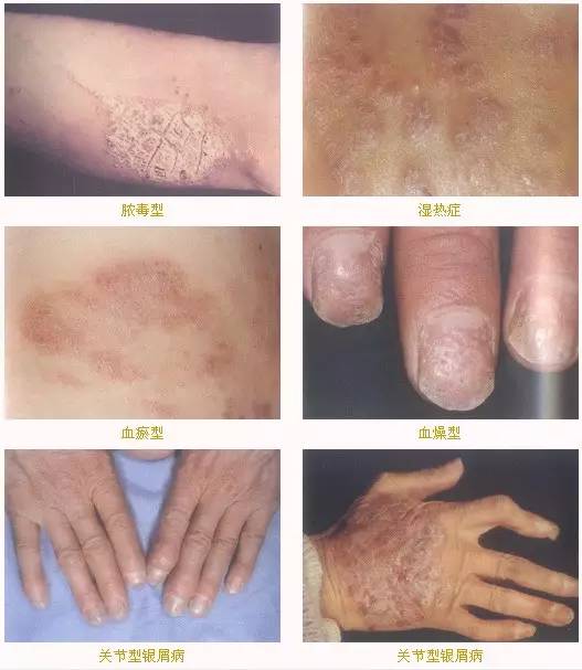 「二院技术」出*麻疹荨**满脸红痕这些皮肤病会“秋后算账”