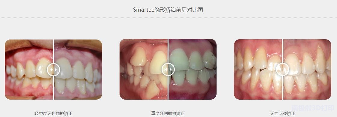 隐形牙套3d打印机,隐形牙套光固化3d打印