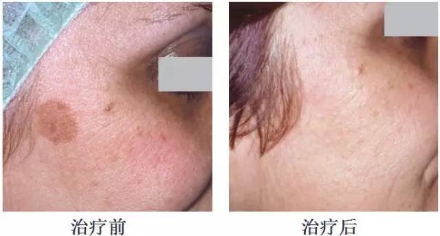 徐医附院美容中心整形案例,徐医附院整形美容中心祛痣