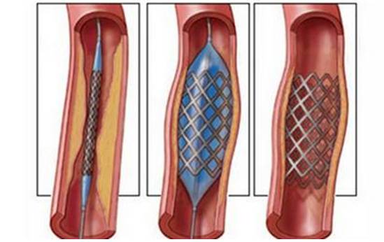 牙齿有金属填充物能不能做磁共振,做磁共振身上带金属会伤害身体吗