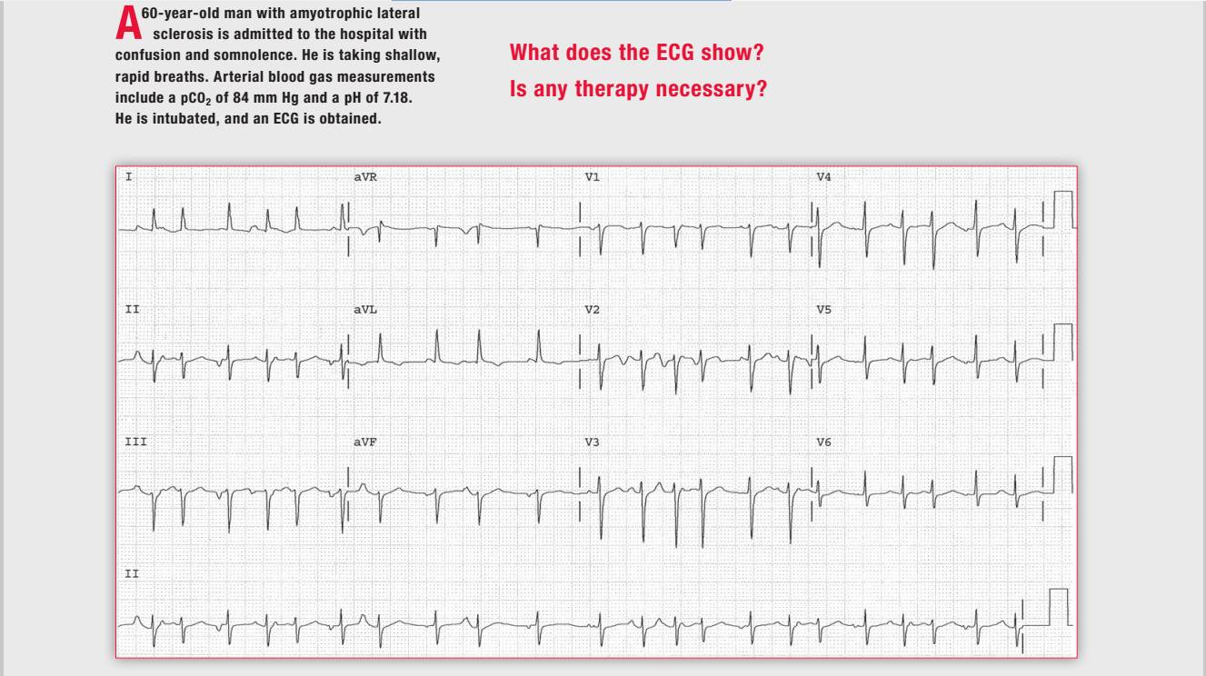 「读心有术」164期：这种多源性房速需要治疗吗？