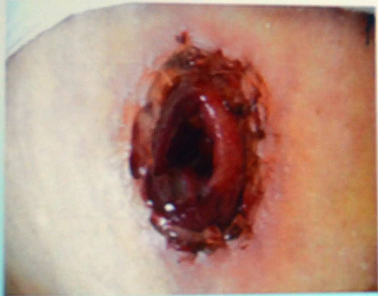 肠造口常见周围皮肤并发症,肠造口手术的并发症