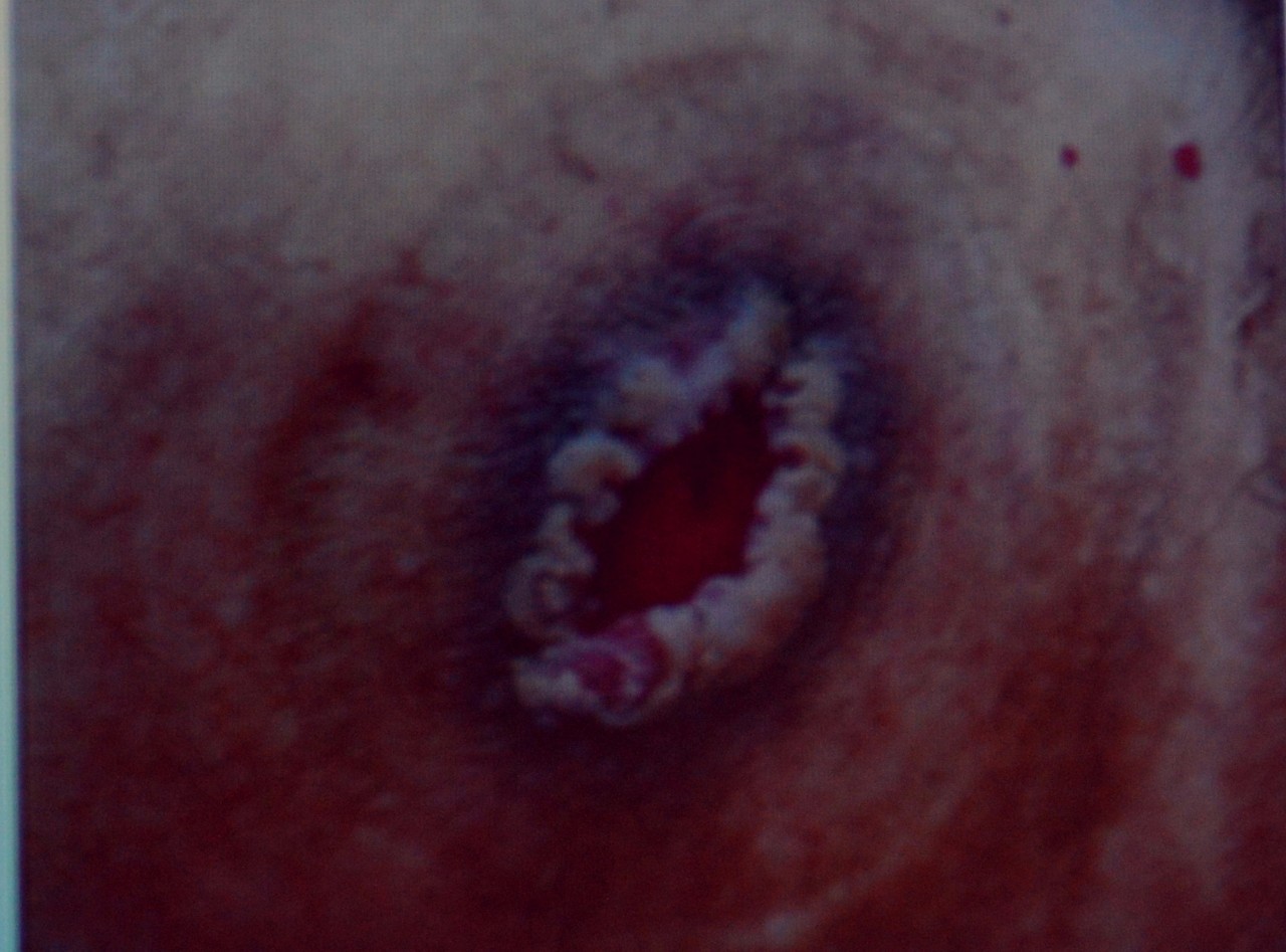 肠造口常见周围皮肤并发症,肠造口手术的并发症